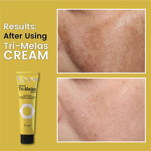 DR Romia Melasma Trimelas Cream - Best Melasma Cream